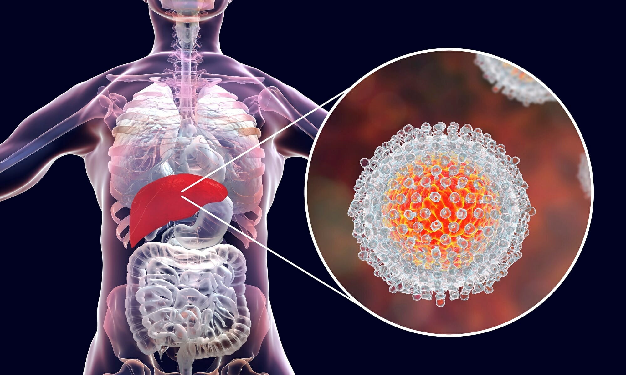 Hepatite C, o que é?